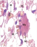 <strong>The brown pigment contained within the macrophages (M)shown in the accompanying high power photomicrograph of a myocardial infarction results from which one of the following physiologic processes? </strong> A)Breakdown of haemoglobin B)Exogenous carbon deposition (anthracosis) C)Macrophage apoptosis D)Melanocyte necrosis E)Oxidation of eosin dye