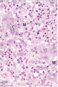 <strong>The highly vascularised soft tissue shown in the accompanying high power photomicrograph is best described by which one of the following phrases? </strong> A)Abscess B)Fibrinous exudate C)Fibrous granulation tissue D)Granuloma E)Granulomatous inflammation F)Vascular granulation tissue