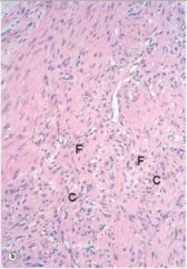 <strong>The healing soft tissue shown in the accompanying medium power photomicrograph is best described by which one of the following phrases? </strong> A)Abscess B)Fibrinous exudate C)Fibrous granulation tissue D)Granuloma E)Granulomatous inflammation F)Vascular granulation tissue