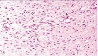 <strong>The healing soft tissue shown in the accompanying photomicrograph contains pink or hyalinised material interspersed between cell nuclei.Which one of the following words or phrases best describes the composition of this pink tissue? </strong> A)Collagen B)Oedema C)Fibrin D)Necrotic tissue E)Protein