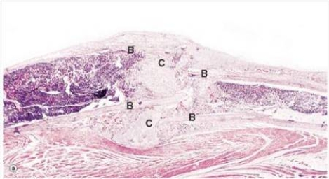 <strong>In the accompanying low power photomicrograph of a healing bone fracture,the tissue designated C is best described by which one of the following words or phrases? </strong> A)Bone B)Callus C)Cartilage D)Chondrocytes E)Haematoma F)Osteoid G)Scar