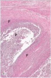 <strong>The structure labelled F in the accompanying photomicrograph of an acute abscess in the colon wall most likely consists of which one of the following substances or cells? </strong> A)Collagen B)Complement C)Fibrin D)Fibroblasts E)Platelets
