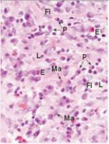 <strong>In the accompanying photomicrograph of healing soft tissue,the cells labelled P comprise which one of the following cell populations?  </strong> A)Eosinophils B)Fibroblasts C)Macrophages D)Neutrophils E)Plasma cells <div style=padding-top: 35px> 