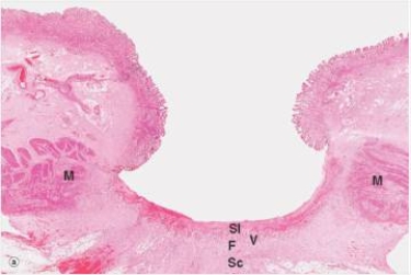 <strong>In the accompanying photomicrograph of a peptic ulcer,the tissue in the base of the ulcer labelled Sl is most likely to contain which one of the following materials or cell types?  </strong> A)Fibroblasts B)Gastric epithelium C)Necrotic cell debris and fibrin D)Neutrophils E)Pancreatic glands <div style=padding-top: 35px> 