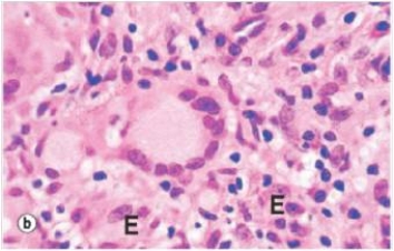 <strong>In the accompanying photomicrograph of a tuberculous granuloma,the multi-nucleated giant cell in the middle is derived from which one of the following cells?  </strong> A)Epithelioid macrophage B)Lymphocyte C)Neutrophil D)Plasma cell E)T cell <div style=padding-top: 35px> 