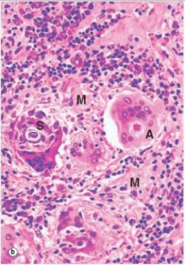 <strong>In the accompanying high power photomicrograph of a lymph node,taken from a patient with sarcoidosis,the multi-nucleated giant cell labelled A contains a characteristic inclusion body known as which one of the following?  </strong> A)Apoptotic body B)Asteroid body C)Eosinophilic body D)Negri body E)Schaumann body <div style=padding-top: 35px> 