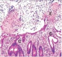 <strong>In the accompanying photomicrograph of colon,a fibrinous exudate (E)is seen erupting from the surface of the colonic mucosa.Which one of the following organisms characteristically causes such a microscopic picture?  </strong> A)Actinomyces israelii B)Clostridium difficile C)Mycobacterium tuberculosis D)Staphylococcus aureus E)Streptococcus pneumonia <div style=padding-top: 35px> 