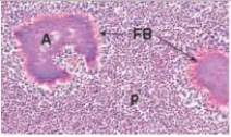 <strong>In the accompanying photomicrograph from a cervical (neck)lymph node,what is the proper terminology for the eosinophilic,proteinaceous halo (seen at the tip of the arrows)around colonies of Actinomyces organisms (labelled A)?  </strong> A)Coagulation B)Necrosis C)Splendori-Hoeppli phenomenon D)Spock-Kirk continuum E)Trilaminar membrane <div style=padding-top: 35px> 