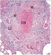 <strong>In the accompanying low power photomicrograph of lung from a patient with tuberculosis,the eosinophilic area labelled CN in the centre of the lesion depicted is best described by which one of the following words or statements?  </strong> A)Apoptosis B)Caseous necrosis C)Cottage cheese degeneration D)Liquifactive necrosis E)Suppurating granuloma <div style=padding-top: 35px> 