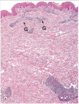 <strong>The accompanying low power photomicrograph of skin is from a person with leprosy.The areas labelled G are granulomas.Which one of the following words or phrases best describes the type of leprosy represented?  </strong> A)Biblical B)Complex C)Simple D)Lepromatous E)Tuberculoid <div style=padding-top: 35px> 