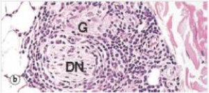 <strong>The accompanying high power photomicrograph of skin,showing a small dermal nerve (DN)is from a person with tuberculoid leprosy.The area labelled G is an associated granuloma.If an acid-fast stain were performed on this section,in an attempt to visualise the leprosy bacilli,which one of the following would you expect to see upon microscopic examination?  </strong> A)Few acid-fast organisms B)Large numbers of acid-fast organisms C)No organisms - acid-fast stains don't work for Mycobacterium leprae <div style=padding-top: 35px> 