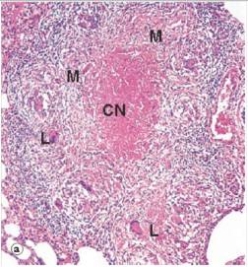 <strong>In the accompanying low power photomicrograph of lung tissue from a patient with tuberculosis,the large cells labelled with an L are best known by which one of the following terms?  </strong> A)Amoeba cells B)Astrocytes C)Langhans' giant cells D)Large cells E)Large lymphocytes <div style=padding-top: 35px> 