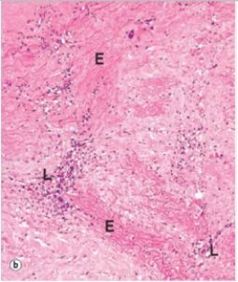 <strong>A 54 year old man presented at the Emergency Department with severe chest pain.A chest x-ray revealed a markedly dilated ascending aorta.Before any further tests could be performed,the patient expired.At autopsy,a markedly dilated aorta was observed,with aortic dissection.The accompanying photomicrograph shows the pathology of the aorta.The letter E denotes elastic fibres,while L shows a lymphoplasmacytic infiltrate around small vessels in the adventitia.Which one of the following is the best explanation for the underlying cause of the patient's demise?  </strong> A)Atherosclerosis B)Congenital elastin deficiency C)Endarteritis obliterans D)Marfan syndrome E)Myocardial infarction <div style=padding-top: 35px> 