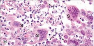 <strong>The accompanying photomicrograph depicts an endoscopic biopsy of the oesophagus from a patient undergoing chemotherapy for gastric cancer.From the microscopic appearance of the syncytial cells (denoted with an S),which one of the following viruses is directly involved in this infection of the oesophagus?  </strong> A)Cytomegalovirus (CMV) B)Human immunodeficiency virus (HIV) C)Human papillomavirus (HPV) D)Herpes simplex virus (HSV) E)Measles virus <div style=padding-top: 35px> 