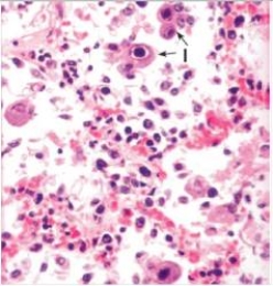 <strong>The accompanying photomicrograph depicts an endoscopic biopsy of lung tissue from a patient undergoing chemotherapy for leukaemia.The arrows point to cells with viral inclusion bodies.Which one of the following viruses is directly involved in this case of viral pneumonitis?  </strong> A)Cytomegalovirus (CMV) B)Human immunodeficiency virus (HIV) C)Human papillomavirus (HPV) D)Herpes simplex virus (HSV) E)Measles virus <div style=padding-top: 35px> 