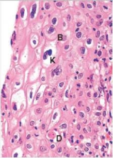 <strong>The accompanying photomicrograph depicts a biopsy of uterine cervix tissue from a 24 year old woman with an abnormal Pap smear.Which one of the following viruses is directly involved in this infection of the squamous mucosa of the cervix?  </strong> A)Cytomegalovirus (CMV) B)Human immunodeficiency virus (HIV) C)Human papillomavirus (HPV) D)Herpes simplex virus (HSV) E)Measles virus <div style=padding-top: 35px> 