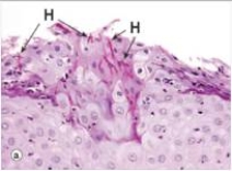 <strong>The accompanying high power photomicrograph shows a biopsy of the buccal mucosa from an immunocompetent patient who had been taking broad spectrum antibiotics.Which one of the following is the best diagnosis?  </strong> A)Aspergillosis B)Candida albicans C)Cryptococcus neoformans D)Herpes simplex virus E)Pneumocystis jirovecii F)Zygomycosis (Mucormycosis) <div style=padding-top: 35px> 