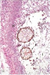 <strong>A 60 year old male was treated with chemotherapy for leukaemia.He developed wedge-shaped infiltrates in his lungs,one of which was biopsied.A representative section is shown in the accompanying photomicrograph.Which one of the following is the best diagnosis?  </strong> A)Candida albicans pneumonitis B)Cryptococcal pneumonia (Cryptococcus neoformans) C)Cytomegalovirus (CMV)pneumonitis D)Disseminated aspergillosis E)Pneumocystis jirovecii pneumonitis <div style=padding-top: 35px> 