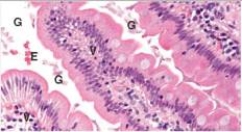 <strong>An otherwise well 24 year old woman was hiking in the mountains.She drank water from a mountain stream,but did not filter it.Two days later,she reported to an Emergency Department with intractable diarrhoea.An endoscopy biopsy of the small intestine was performed.A representative section is shown in the accompanying photomicrograph.Which one of the following infectious organisms is the most likely cause of these symptoms?  </strong> A)Candida albicans B)Cytomegalovirus (CMV) C)Entamoeba histolytica D)Giardia lamblia E)Trichomonas vaginalis <div style=padding-top: 35px> 