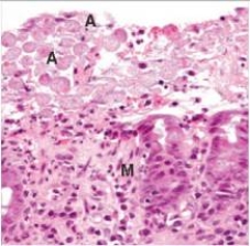 <strong>An otherwise well 43 year old man visited Mexico.He was well until he returned to the United States a few days later,whereupon he experienced bloody diarrhoea and crampy abdominal pain.Because of the possibility of parasitic infection,a colonic biopsy was performed.A representative section from the procedure is shown in the accompanying photomicrograph.Based upon the histopathologic findings,which one of the following is the best diagnosis?  </strong> A)Candida albicans B)Cytomegalovirus (CMV) C)Entamoeba histolytica D)Giardia lamblia E)Trichomonas vaginalis <div style=padding-top: 35px> 