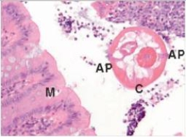 <strong>A 6 year old boy was brought to the Emergency Department by his mother because of increasing pain in the right lower abdomen.A diagnosis of appendicitis was made,and the appendix was removed laparoscopically.A representative section of the appendix is shown in the accompanying high power photomicrograph.Which one of the following is the best diagnosis of the cause of the boy's appendicitis?  </strong> A)Entamoeba histolytica B)Enterobius vermicularis C)Giardia lamblia D)Schistosoma haematobium E)Trichomonas vaginalis <div style=padding-top: 35px> 