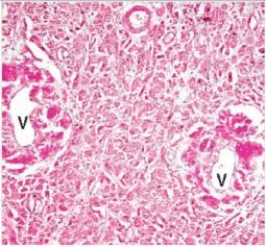 <strong>A 37 year old woman died of congestive heart failure.An autopsy was requested by the family because her sister had also died at a young age of congestive heart failure.At autopsy,the heart was enlarged,and had a waxy,pale appearance.A representative section is shown in the accompanying photomicrograph.Which one of the following is the best diagnosis? </strong> A)Localised senile amyloid B)Systemic heredofamilial amyloidosis C)Systemic amyloidosis due to multiple myeloma D)Systemic senile amyloidosis