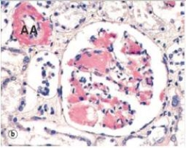 <strong>A 58 year old woman was seen by a nephrologist for chronic renal failure.She had a 20 year history of rheumatoid arthritis.A renal biopsy was performed,and a representative glomerulus is shown in the accompanying photomicrograph,stained with Sirius Red.Which one of the following is the best diagnosis for the cause of her renal failure? </strong> A)Acute glomerulonephritis B)Diabetic glomerulosclerosis C)Systemic amyloidosis D)Systemic hypertension