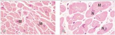 <strong>Normal myocardium is shown in the left hand panel of the accompanying photomicrograph,whereas the right hand panel shows abnormal myocardium.Which one of the following is the most likely pathophysiologic explanation for the changes seen in the myocardium on the right?  </strong> A)Acute inflammation,due to myocardial infarction B)Ageing C)Cancer of the myocardium D)Increased number of cells E)Increased synthesis of proteins and intermediate filaments <div style=padding-top: 35px> 