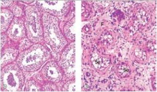 <strong>Normal testis tissue is shown in the left hand panel of the accompanying photomicrograph,whereas the right hand panel shows abnormal testis.Which one of the following is the most likely pathophysiologic explanation for the changes seen in the testis on the right?  </strong> A)Acute inflammation B)Ageing C)Cancer of the testis (seminoma) D)Increased number of cells E)Increased synthesis of proteins and intermediate filaments <div style=padding-top: 35px> 