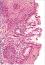 <strong>A 54 year old man had been experiencing heartburn for a number of years.His physician eventually decided to recommend upper GI endoscopy.A mid-oesophagus biopsy sample is shown in the accompanying photomicrograph.Which one of the following is the best diagnosis?  </strong> A)Acute inflammation B)Barrett's oesophagus C)Colonic hyperplasia D)Gastric hypertrophy E)Giardia lamblia infection <div style=padding-top: 35px> 