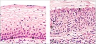 <strong>A 24 year old woman underwent biopsy of the uterine cervix because of an abnormal Pap smear.A representative section of the biopsy is shown in panel b of the accompanying photomicrograph.Panel a is a normal uterine cervix for comparison.Which one of the following is the best diagnosis? </strong> A)Invasive squamous cell carcinoma B)Squamous cell atrophy C)Squamous cell dysplasia D)Squamous cell hyperplasia E)Squamous cell metaplasia