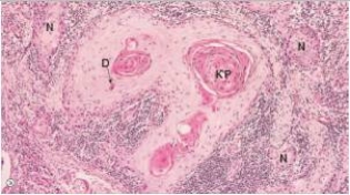 <strong>A 67 year old woman was found to have metastatic nodules in her lung upon routine chest x-ray.A thoracoscopic biopsy of one of these nodules disclosed the histology seen in the accompanying photomicrograph.Which one of the following tissues is the most likely source for the metastatic neoplasm? </strong> A)Bladder B)Breast C)Colonic mucosa D)Oesophagus E)Pancreas