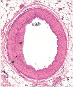 <strong>In the accompanying photomicrograph of a small artery,the abnormality labelled IP refers to which one of the following?  </strong> A)Iconographic proliferation B)Idiopathic protein C)Initial peninsula D)Intimal proliferation E)Ischemic portion <div style=padding-top: 35px> 