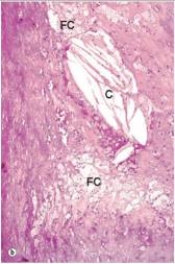 <strong>A high power view of an arterial wall is shown in the accompanying photomicrograph.In the portion of the field labelled C,which one of the following is responsible for the elongated,empty spaces seen?  </strong> A)Coagulative necrosis B)Cholesterol crystals C)Liquifactive necrosis D)Technical error E)Uric acid crystals <div style=padding-top: 35px> 