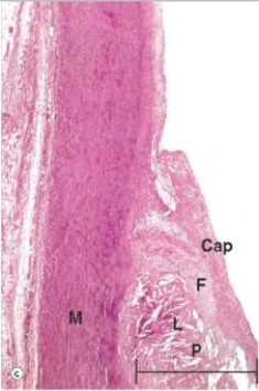 <strong>A high power view of an arterial wall is shown in the accompanying photomicrograph.Which one of the following words or statements is the best classification of the atheromatous plaque shown?  </strong> A)Fatty streak B)Fibrofatty plaque C)Fibrous plaque D)Intimal proliferation E)Necrotic plaque <div style=padding-top: 35px> 