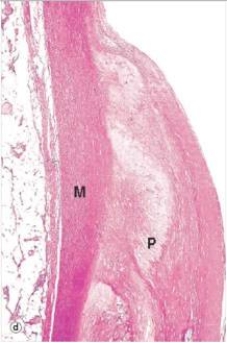 <strong>A high power view of an arterial wall is shown in the accompanying photomicrograph.Which one of the following words or statements is the best classification of the atheromatous plaque shown?  </strong> A)Fatty streak B)Fibrofatty plaque C)Fibrous plaque D)Intimal proliferation E)Necrotic plaque <div style=padding-top: 35px> 