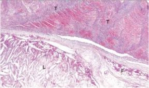<strong>A high power view of an arterial wall is shown in the accompanying photomicrograph.The area labelled T is best described by which one of the following words or phrases?  </strong> A)Acute inflammation B)Cholesterol crystals C)Fibrofatty plaque D)Intimal proliferation E)Thrombus <div style=padding-top: 35px> 