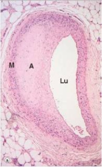 <strong>The accompanying photomicrograph shows narrowing of an artery by an atheroma (A).Which one of the following would be the likely clinical symptom(s)if the artery in question were a coronary artery?  </strong> A)Angina pectoris B)Cramping of heart muscle C)Myocardial infarction D)Tingling in the skin over the heart E)Ventricular fibrillation <div style=padding-top: 35px> 
