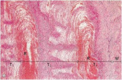 <strong>The accompanying photomicrograph shows alternating layers of a thrombus.This layering effect is known by which one of the following terms? </strong> A)Alternating current B)Bilayer cementing C)Lines of Zahn D)Zebra stripes