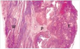 <strong>The accompanying low power photomicrograph of the left ventricle shows a thrombus (T)in the heart of a 66 year old man who died of a heart attack.Which one of the following factors most likely explains the underlying pathophysiologic reason for a thrombus to occur in this area? </strong> A)Endocardial (endothelial)damage B)Hypercoagulability C)Hypertension D)Inflammation E)Vasospasm