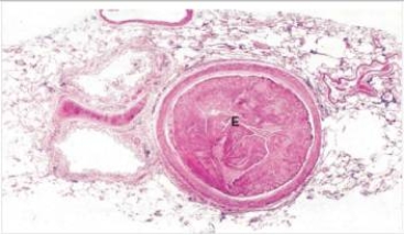 <strong>This low power photomicrograph of the lung shows a thromboembolism within a pulmonary artery.What is the most likely source for this thrombus? </strong> A)Deep leg veins B)Left atrium C)Left ventricle D)Likely formed in situ on top of an atherosclerotic plaque E)Right atrium F)Right ventricle G)Vena cava