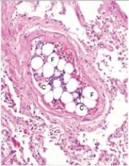 <strong>This medium power photomicrograph of a small artery likely depicts the result of which one of the following pathophysiologic events? </strong> A)Atherosclerosis B)Fracture of a long bone C)Organisation D)Recanalisation E)Therapeutic embolisation F)Thromboembolism