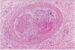 <strong>This medium power photomicrograph of a small artery depicts the result of which one of the following pathophysiologic events? </strong> A)Atherosclerosis B)Fracture of a long bone C)Organisation D)Recanalisation E)Therapeutic embolisation F)Thromboembolism