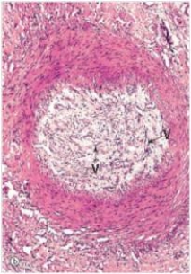 <strong>This medium power photomicrograph of a small artery depicts the results of which one of the following pathophysiologic events? </strong> A)Atherosclerosis B)Fracture of a long bone C)Organisation D)Recanalisation E)Therapeutic embolisation F)Thromboembolism