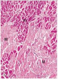 <strong>In the accompanying high power photomicrograph of infarcted myocardium tissue,which one of the following estimates of the age of the infarct is most likely correct? </strong> A)1-2 hours B)4-24 hours C)2-3 days D)10 days E)2 weeks F)1 year