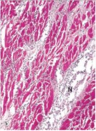 <strong>In the accompanying high power photomicrograph of infarcted myocardium tissue,which one of the following estimates of the age of the infarct is most likely correct? </strong> A)1-2 hours B)4-24 hours C)2-3 days D)10 days E)2 weeks F)1 year