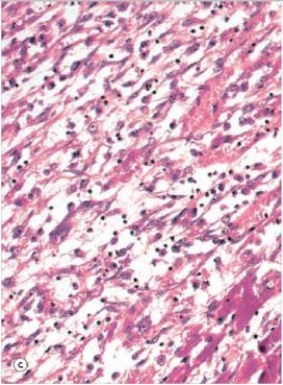 <strong>In the accompanying high power photomicrograph of infarcted myocardium tissue,which one of the following estimates of the age of the infarct is most likely correct? </strong> A)1-2 hours B)4-24 hours C)2-3 days D)10 days E)2 weeks F)1 year