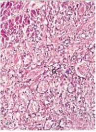 <strong>In the accompanying high power photomicrograph of infarcted myocardium tissue,which one of the following estimates of the age of the infarct is most likely correct? </strong> A)1-2 hours B)4-24 hours C)2-3 days D)10 days E)2 weeks F)1 year