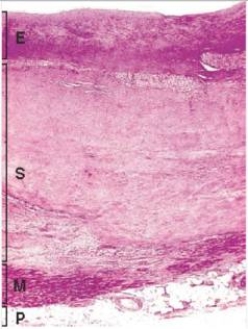 <strong>In the accompanying high power photomicrograph of infarcted myocardium tissue,which one of the following estimates of the age of the infarct is most likely correct? </strong> A)1-2 hours B)4-24 hours C)2-3 days D)10 days E)2 weeks F)1 year
