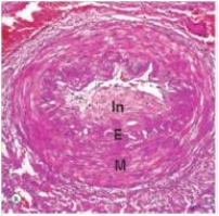 <strong>In this medium power photomicrograph of a medium artery in a patient with systemic hypertension,the area of the image labelled In depicts which one of the following pathologic processes?  </strong> A)Intimal necrosis B)Intimal proliferation C)Thrombosis D)Organisation E)Recanalisation <div style=padding-top: 35px> 